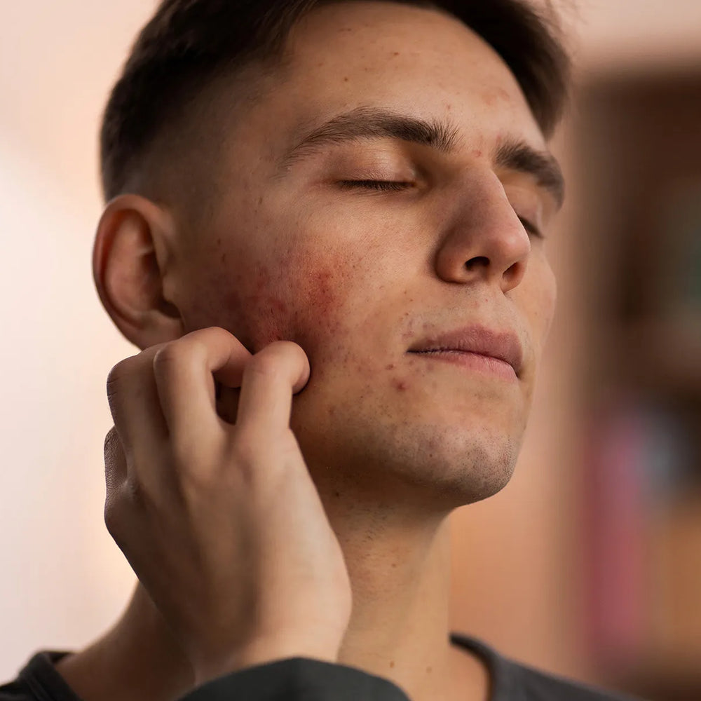 Does Moisturizer Cause Acne? 7 Signs You’re Using Over-Moisturizing