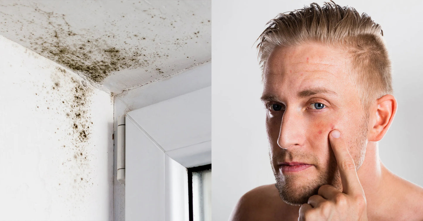 Can Mold Cause Acne? Here’s Everything You Need to Know
